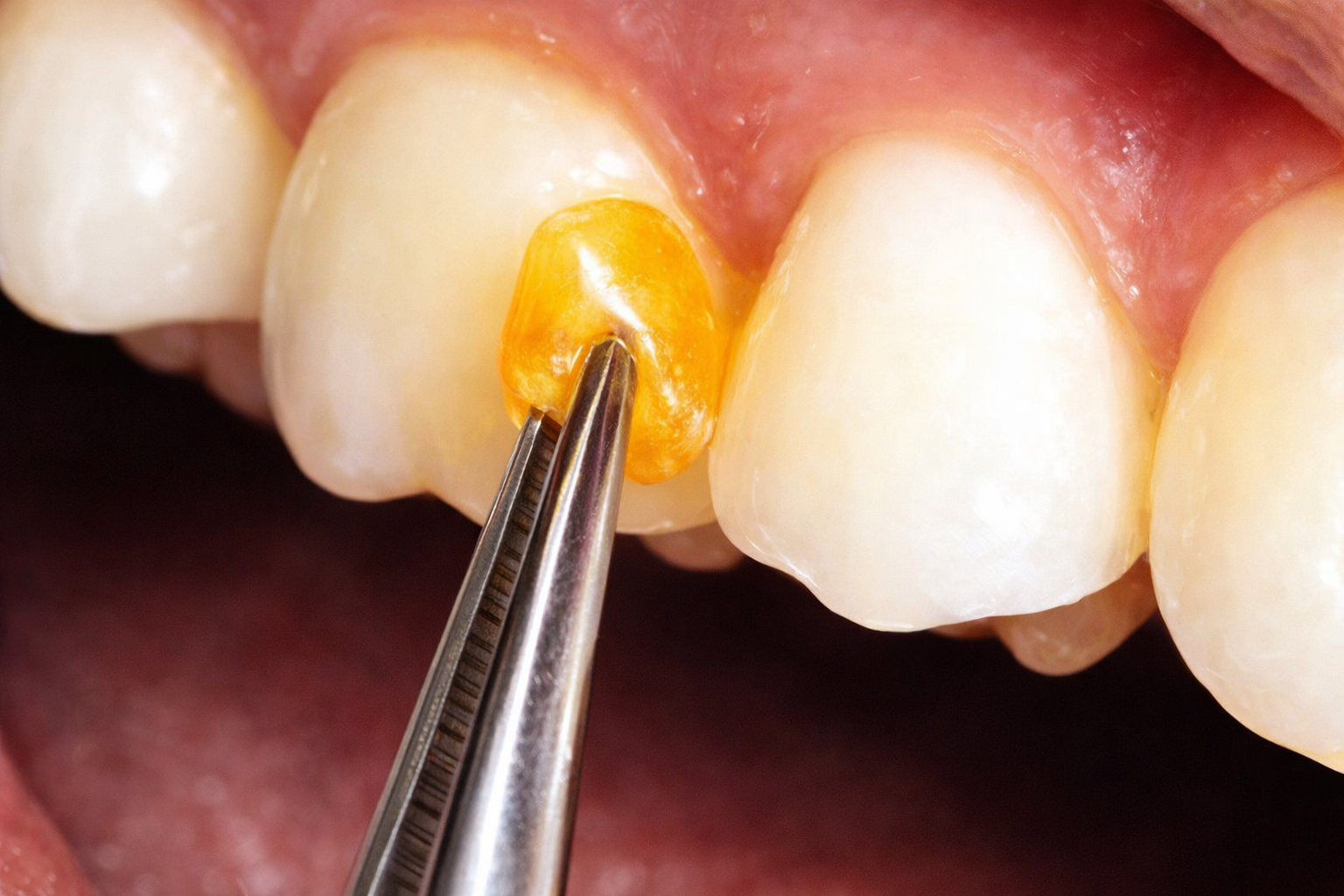 Perio Heal - perio chip